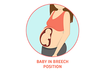 chiropractic care for breech babies